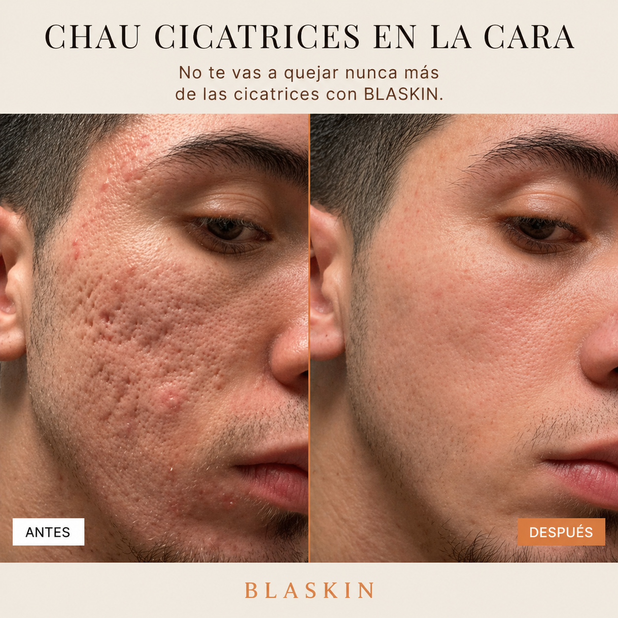 BLASKIN Crema Remodeladora de Cicatrices de Acné - 50ml