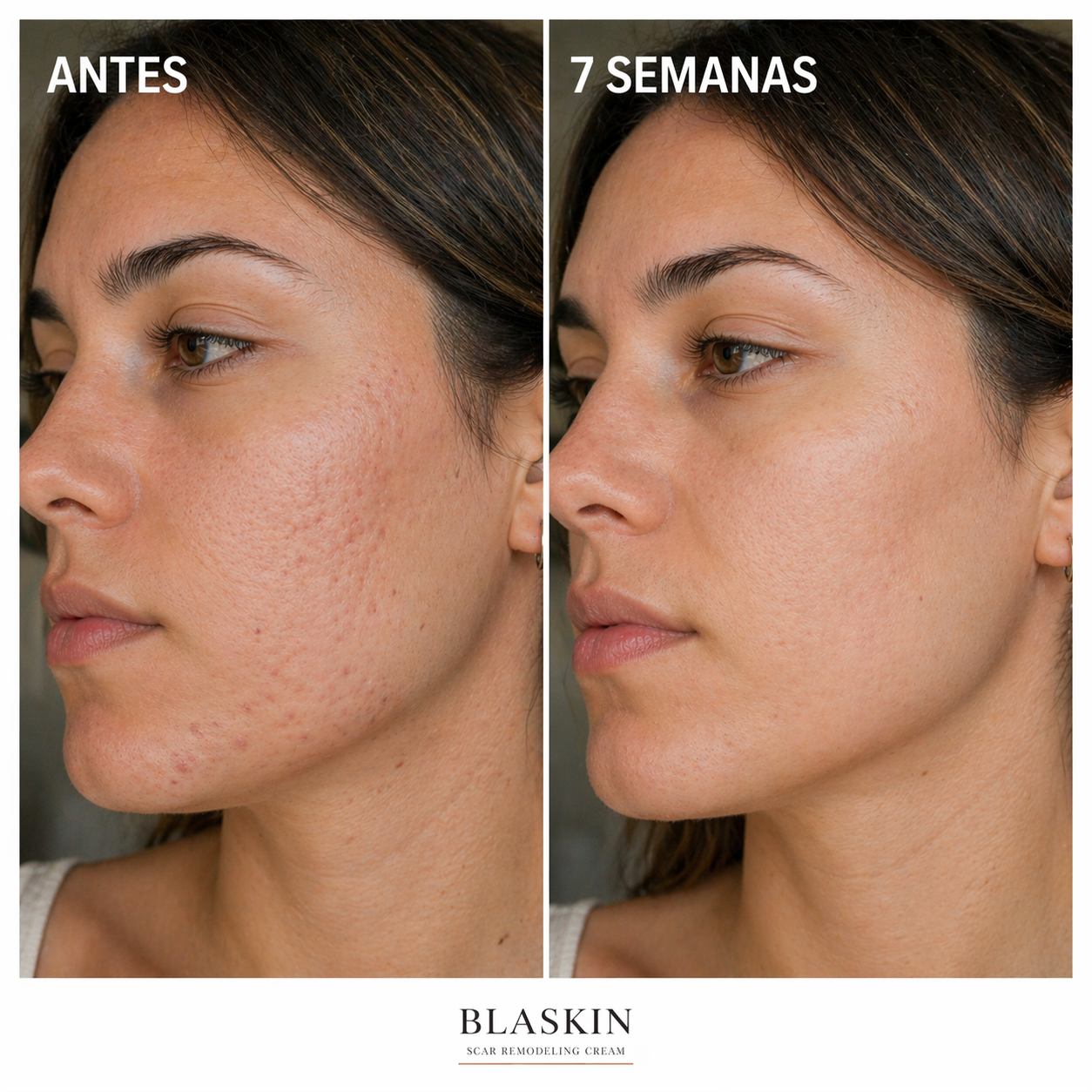 BLASKIN Crema Remodeladora de Cicatrices de Acné - 50ml